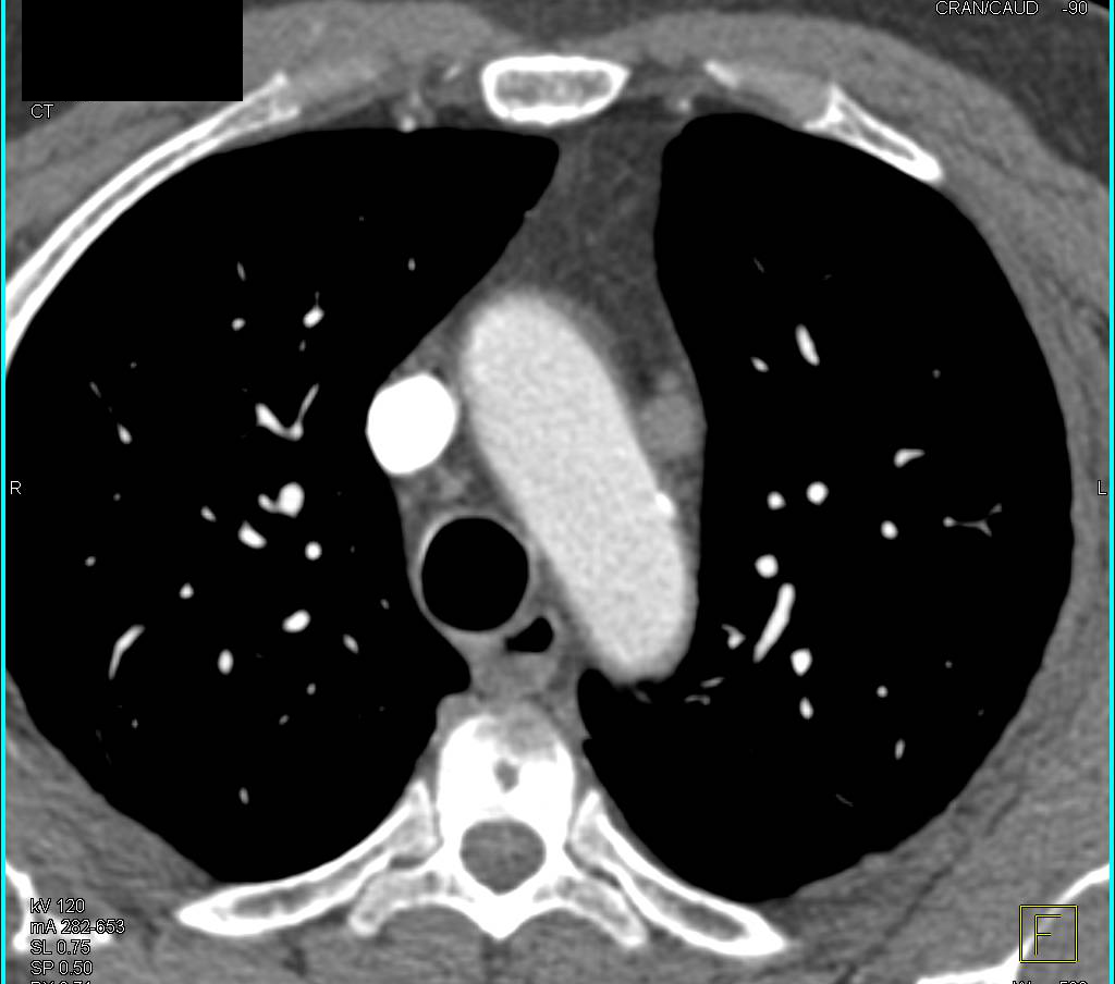 Ectopic Parathyroid Adenoma in the Mediastinum - CTisus CT Scan