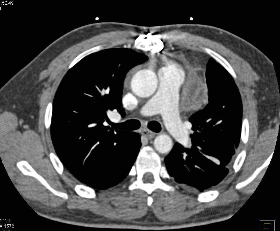 Mediastinal Hematoma - CTisus CT Scan