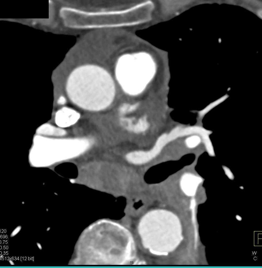 Non-small Cell Lung Cancer Occludes Left Mainstem Bronchus with Vascular Encasement - CTisus CT Scan