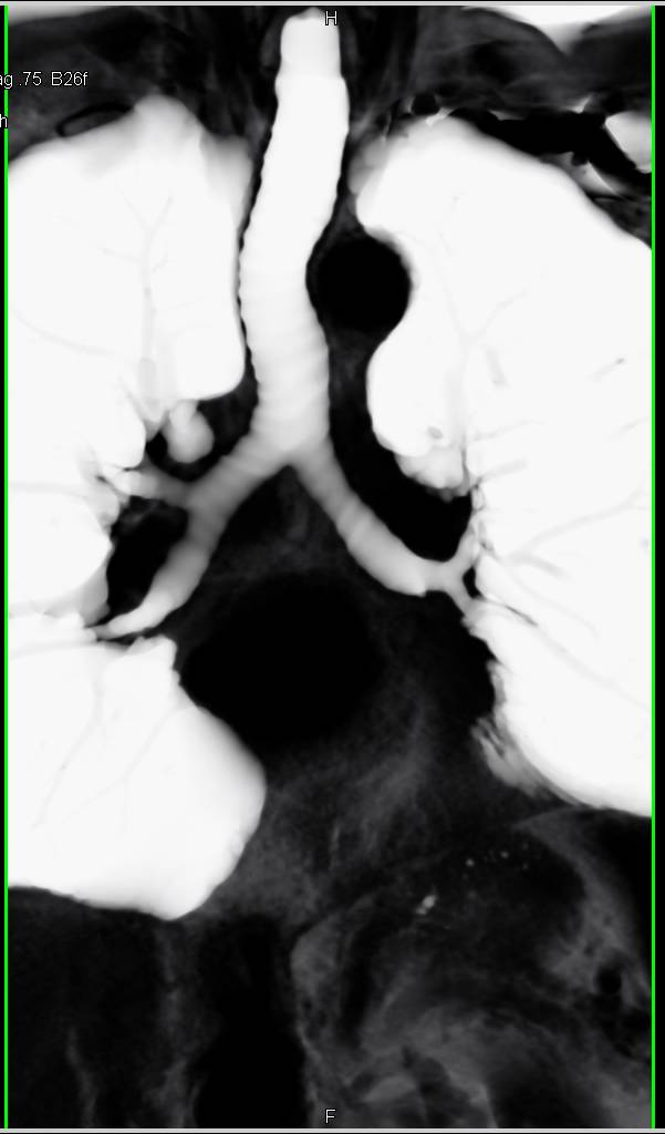 Virtual Bronchoscopy Shows Non-small Cell Lung Cancer Occludes Left Mainstem Bronchus - CTisus CT Scan