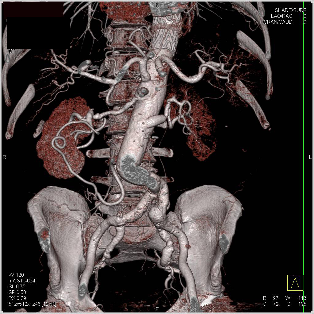 Endovascular Stent in Descending Thoracic Aorta as well as Superior Mesenteric Artery (SMA) Dissection - CTisus CT Scan