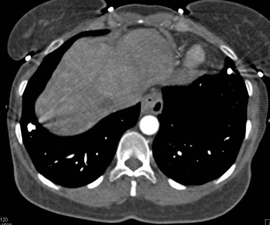 Hereditary Hemorrhagic Telangiectasia (HHT) Disease with Pulmonary and Hepatic Arteriovenous Malformations (AVMs) - CTisus CT Scan