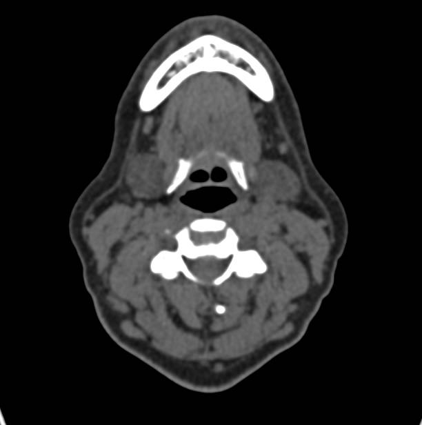 Mild Tracheal Stenosis on Virtual Imaging - CTisus CT Scan