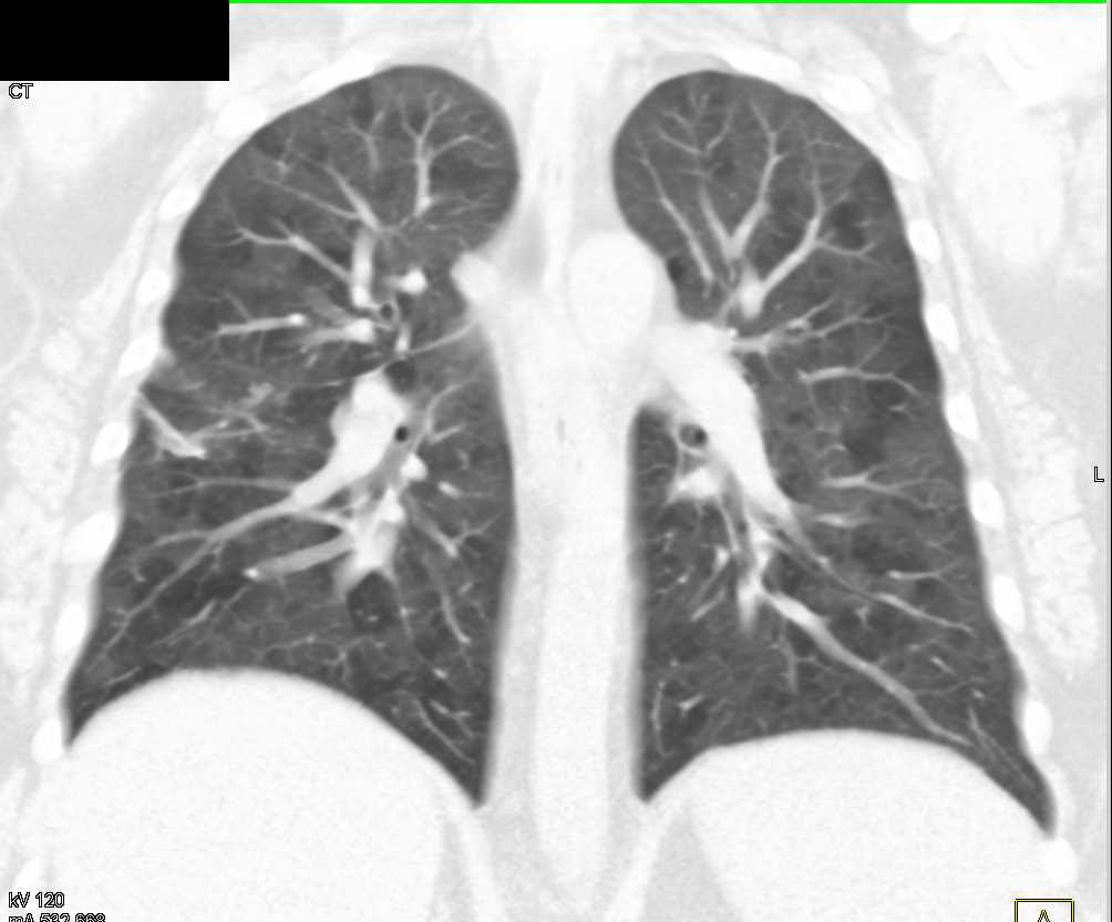Cystic Changes in The Lung - CTisus CT Scan