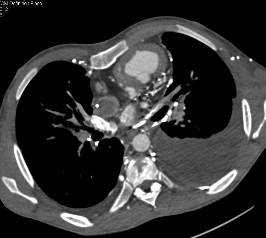 Superior Vena Cava (SVC) Occlusion with Extensive Collaterals - CTisus CT Scan