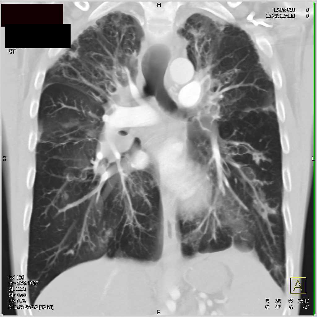 Cystic Fibrosis with Bronchiectasis - CTisus CT Scan