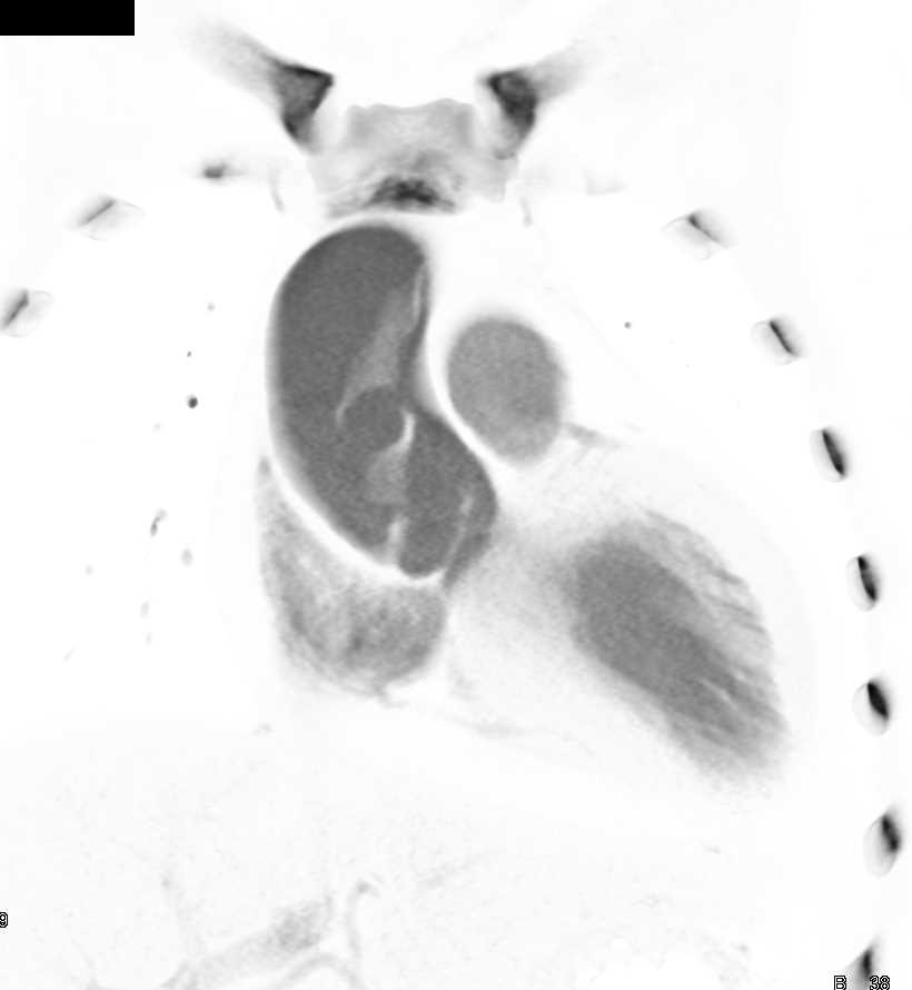 Type A Aortic Dissection - CTisus CT Scan