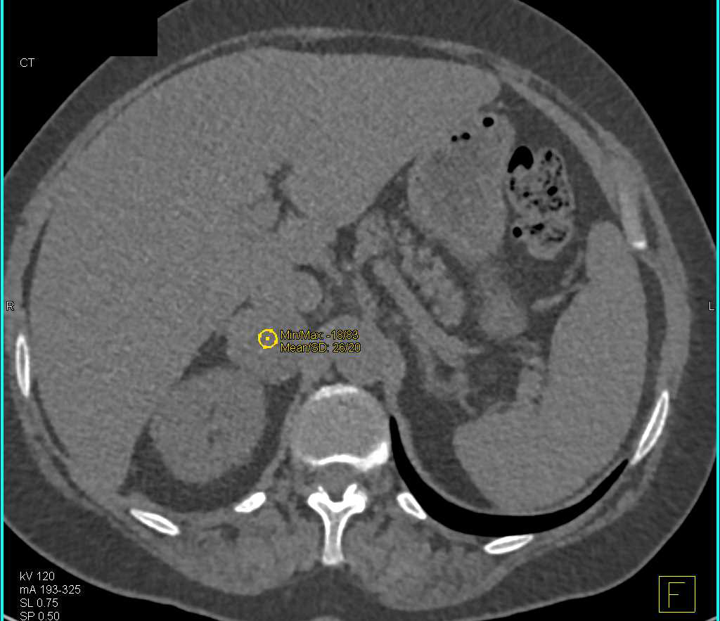 Metastatic Lung Cancer to the Adrenal - CTisus CT Scan