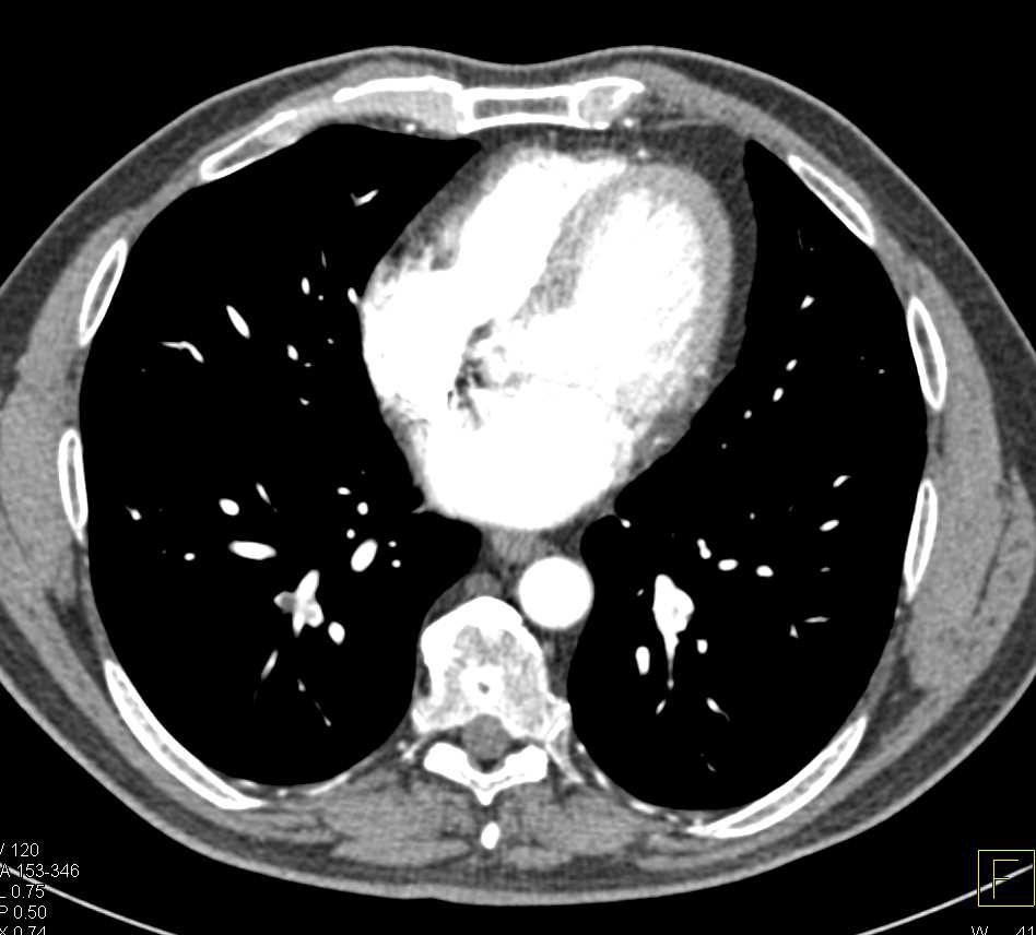 Incidental Pulmonary Embolism (PE) in the Right Lower Lung - CTisus CT Scan