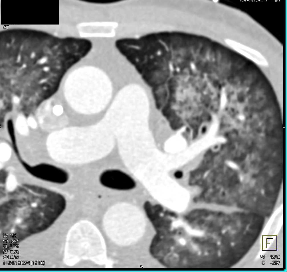 Hemopytsis and Pulmonary Hemorrhage - CTisus CT Scan