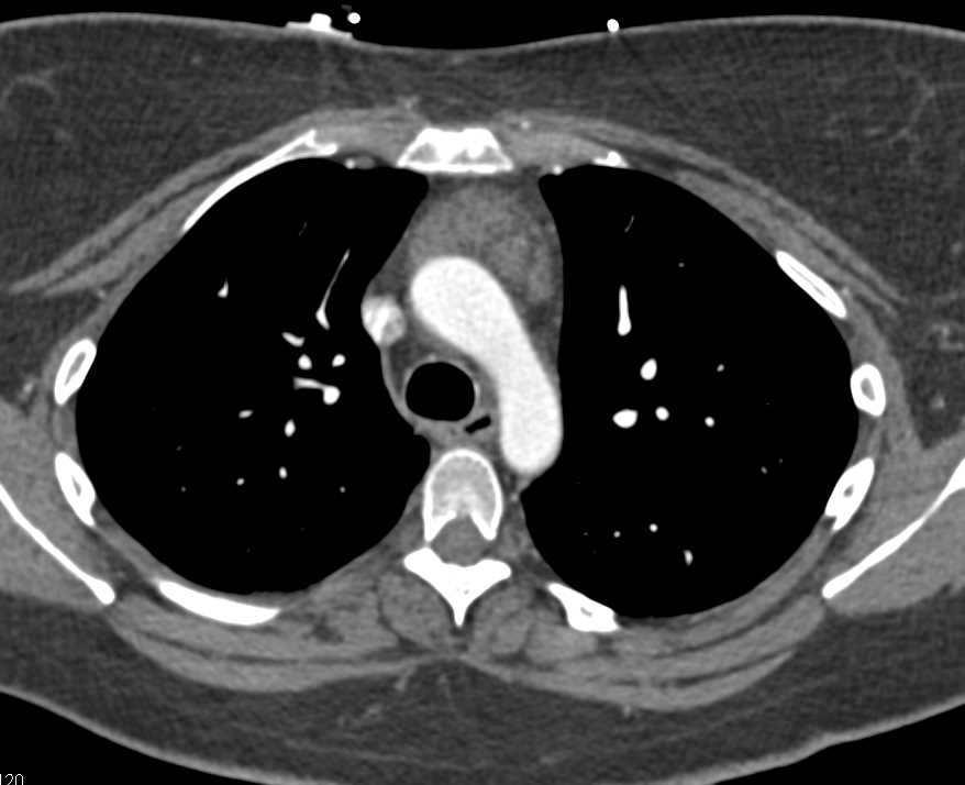 Prominent Thymus - CTisus CT Scan