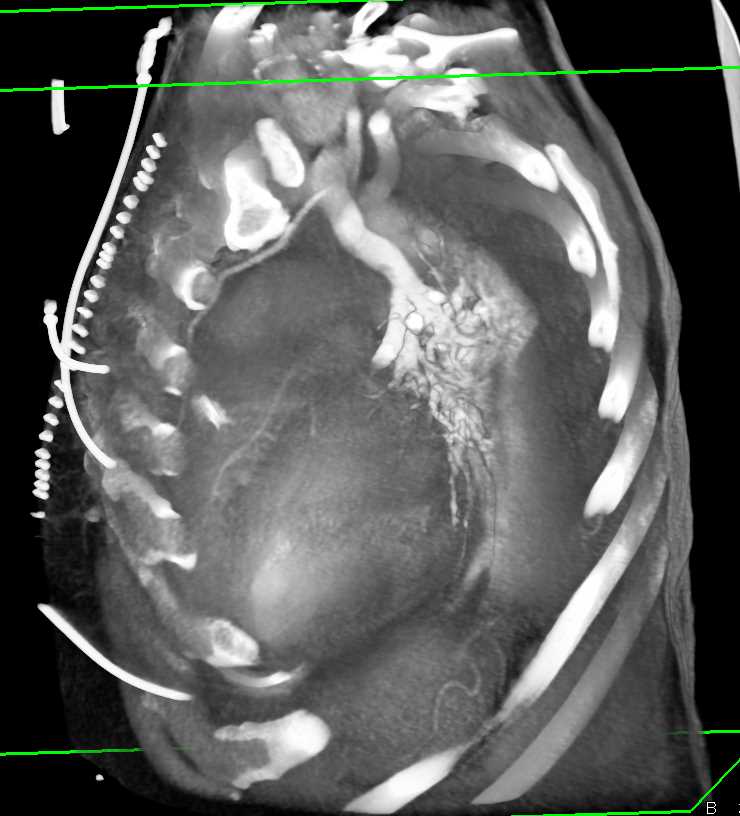 Duplicated Superior Vena Cavas (SVCs) - CTisus CT Scan