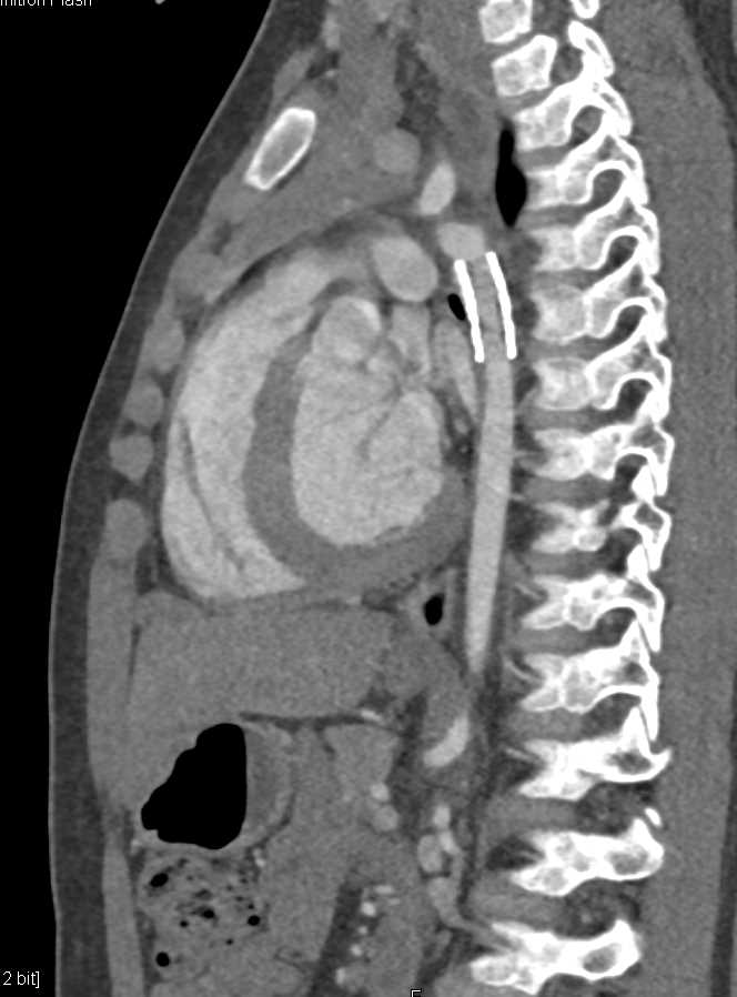 Stent Repair of Coarctation of the Aorta - CTisus CT Scan
