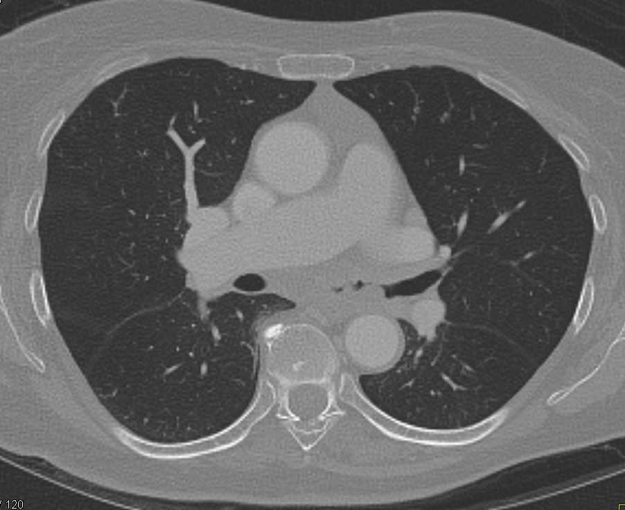 Virtual Imaging with Tumor Encases Left Mainstem Bronchus - CTisus CT Scan