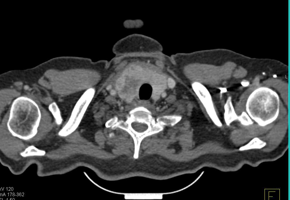 Lung Cancer with Pleural Metastases - CTisus CT Scan
