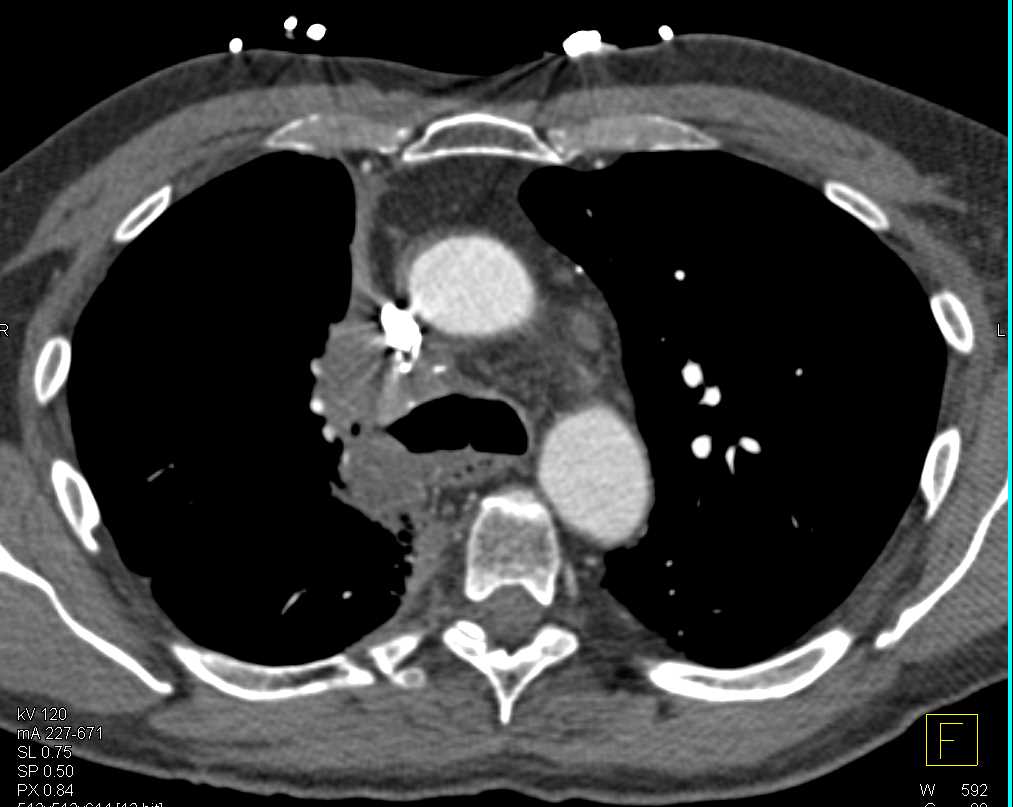 Small Cell Lung Cancer with Changes S/P Radiation Therapy - CTisus CT Scan