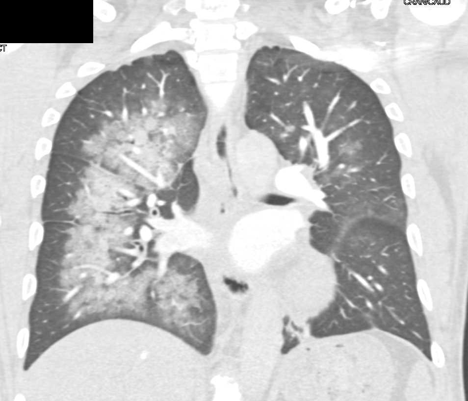 Batwing Configuration due to Pulmonary Hemorrhage - CTisus CT Scan