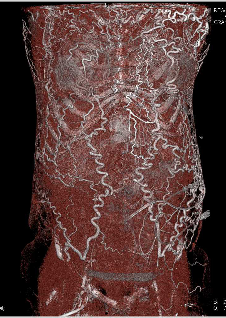 Superior Vena Cava (SVC) Occlusion with Extensive Chest Wall Collaterals - CTisus CT Scan