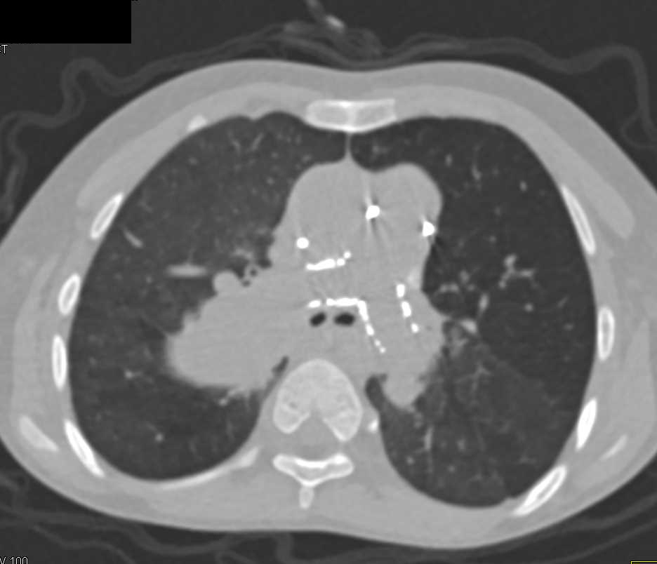 Pulmonary Artery Aneurysm of Right Main Pulmonary Artery - CTisus CT Scan