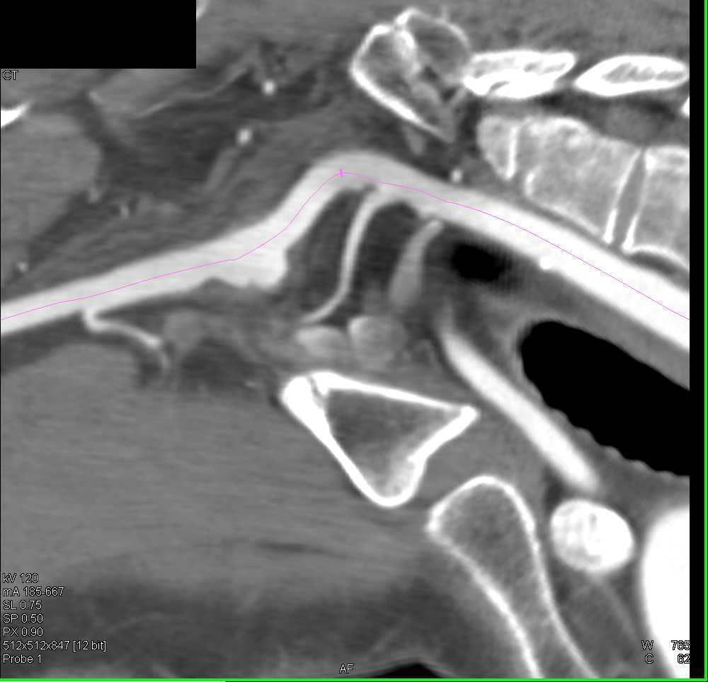 Right Subclavian Artery Aneurysm - CTisus CT Scan