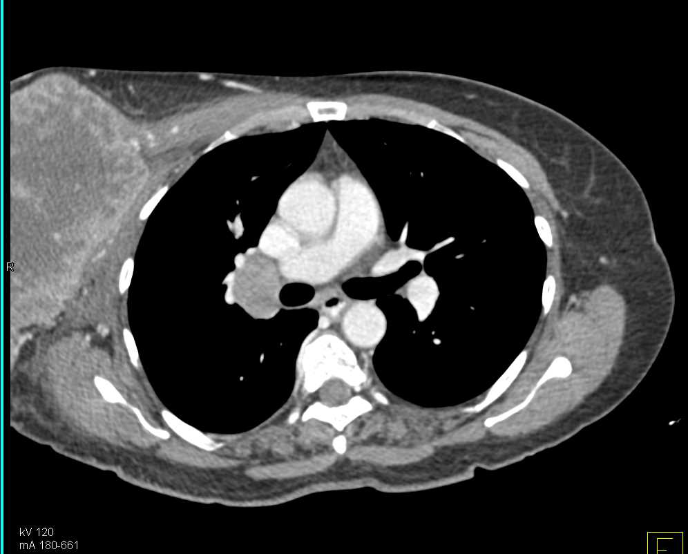 Large Ulcerating Carcinoma Right Breast - CTisus CT Scan