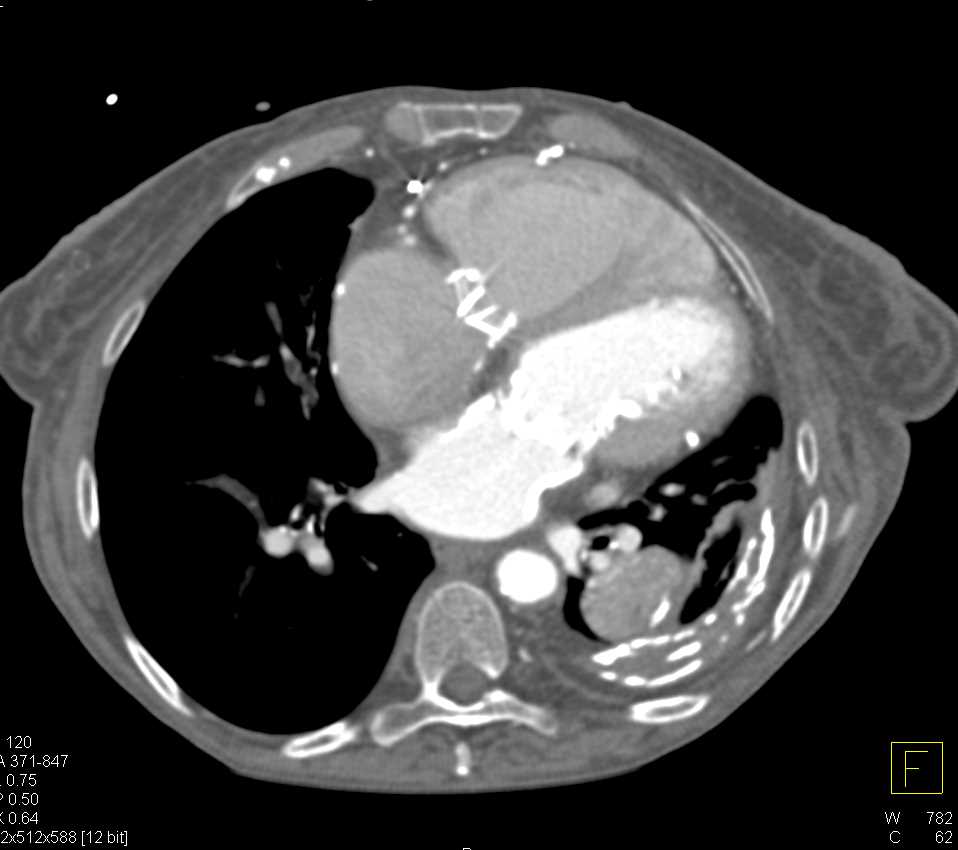 Prior Empyema - CTisus CT Scan