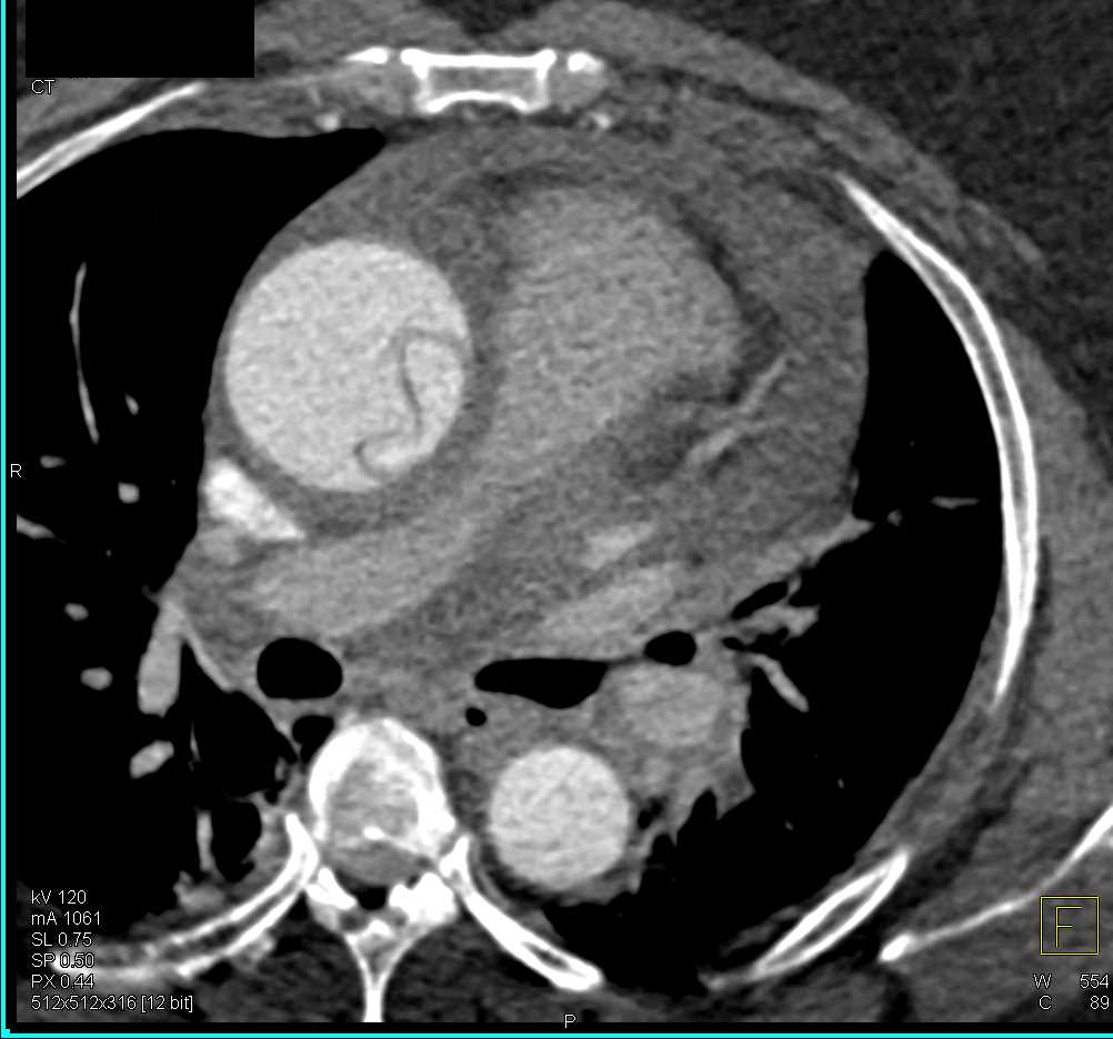 Type A Dissection - CTisus CT Scan