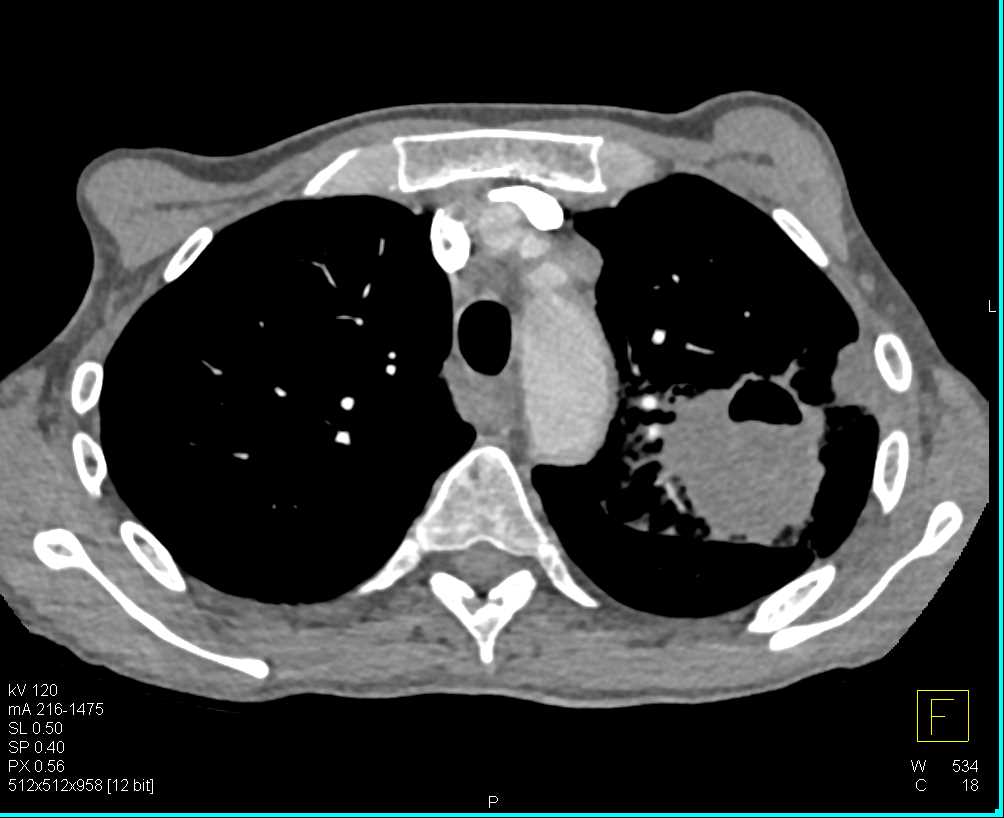 Cavitary Squammous Cell Carcinoma with Adenopathy - CTisus CT Scan