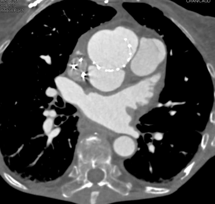 Pseudoaneurysm of the Aortic Root Following Aortic Valve Replacement (AVR) - CTisus CT Scan