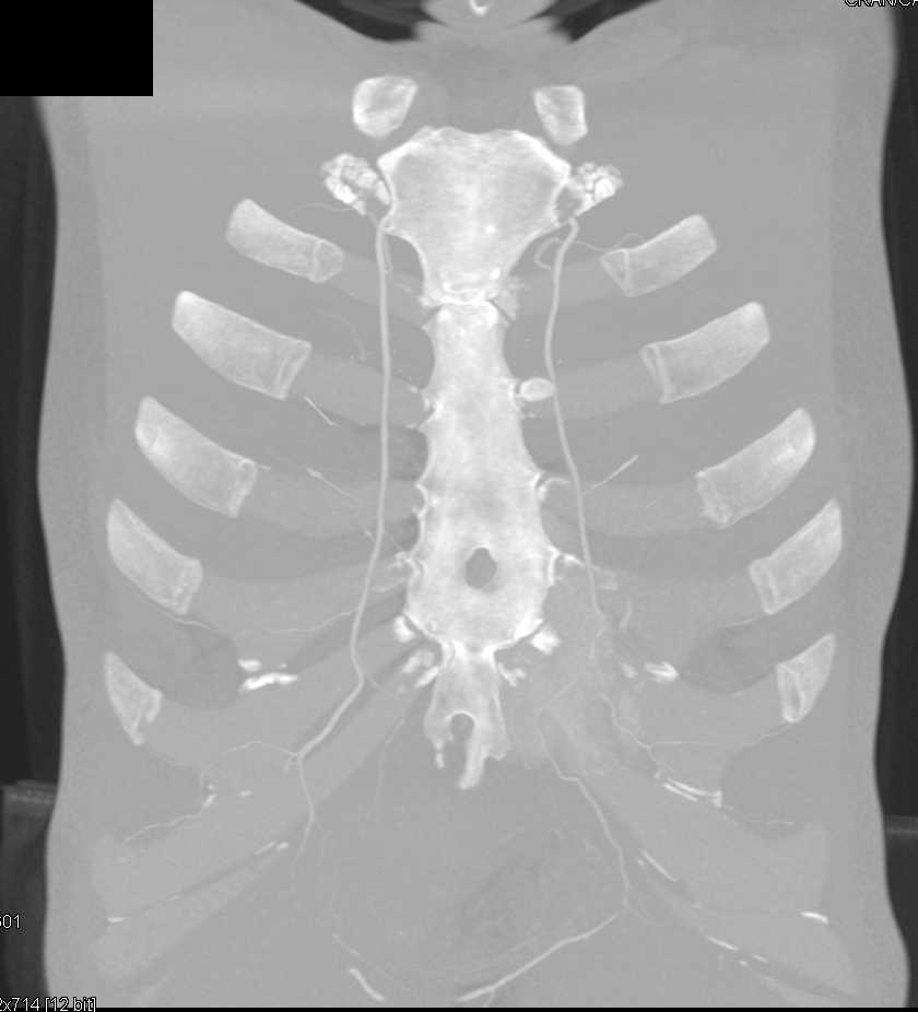 Pulmonary Arteriovenous Malformation (PAVM) with Prior Embolization - CTisus CT Scan