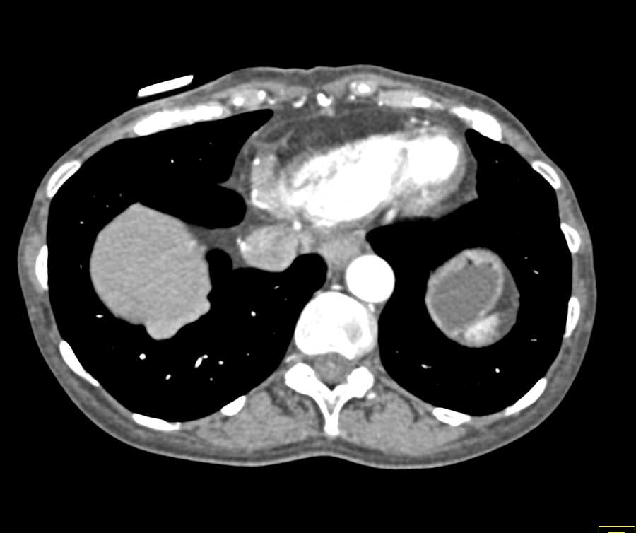 Pleural Implants and Carcinomatosis - CTisus CT Scan