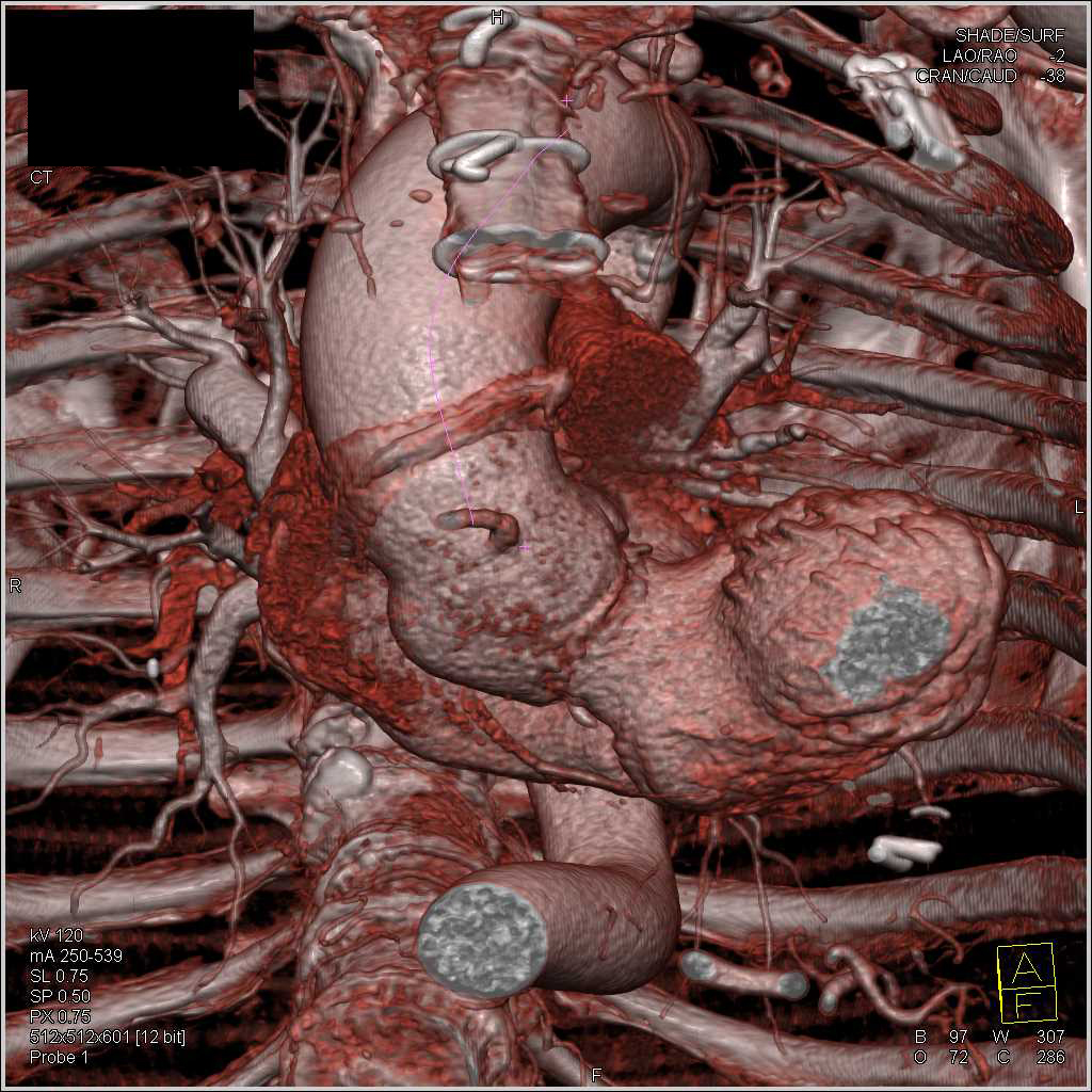 Aortic Valve Replacement With Dilated Ascending Aorta - CTisus CT Scan
