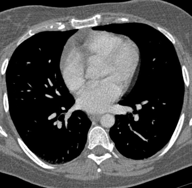 Thymic Hyperplasia - CTisus CT Scan