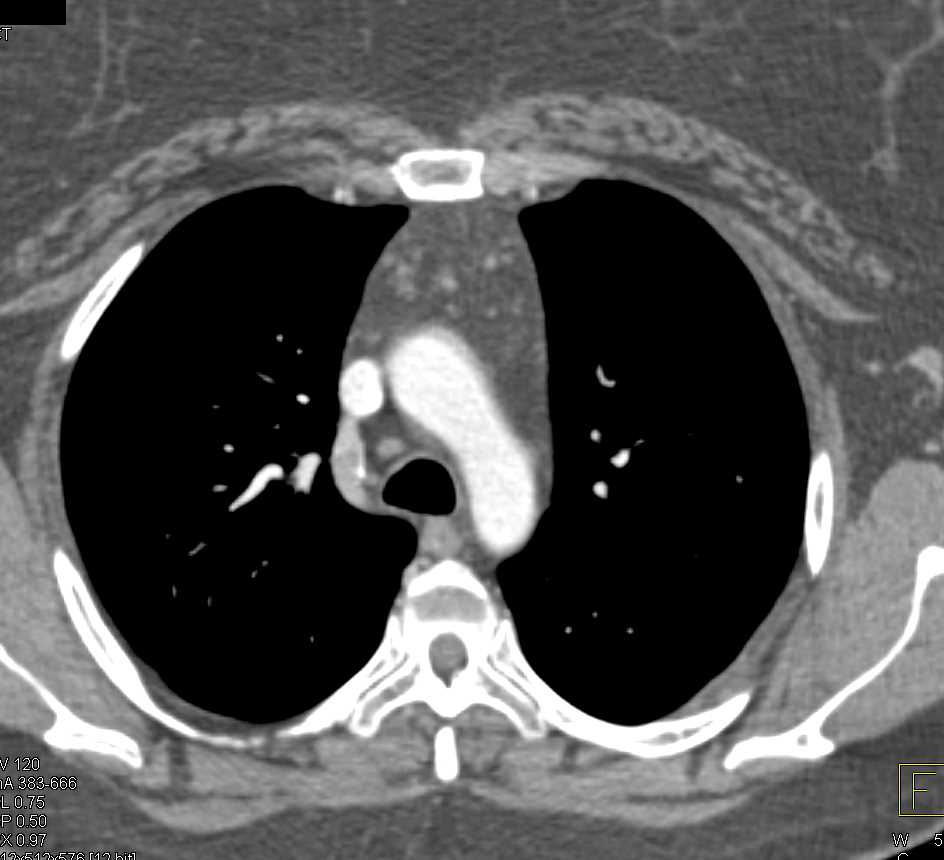 Fatty Infiltration of the Thymus Gland - CTisus CT Scan