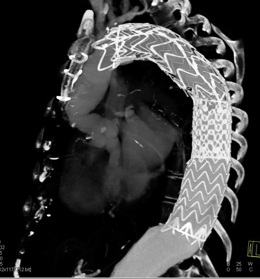 Endovascular Stent in Thoracic Aorta - CTisus CT Scan