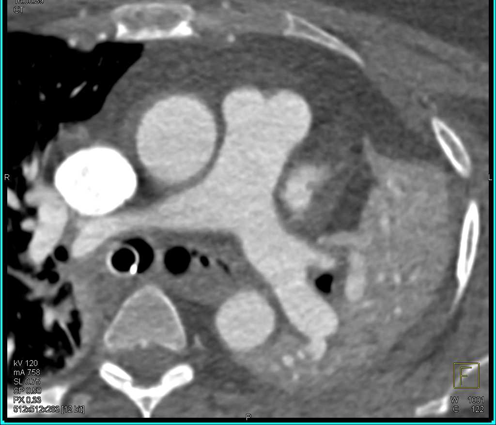 Endotracheal Tube in Right Mainstem Bronchus and Mucoid Impaction in Left Mainstem Bronchus - CTisus CT Scan