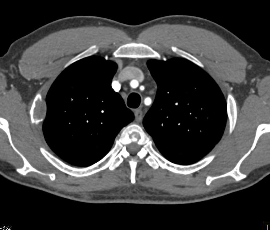 Lung Mass and Rib Metastases - CTisus CT Scan