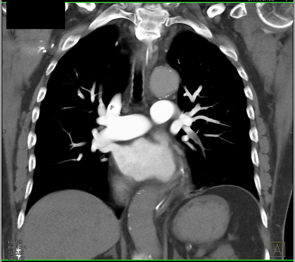 Bilateral Pulmonary Embolism - CTisus CT Scan