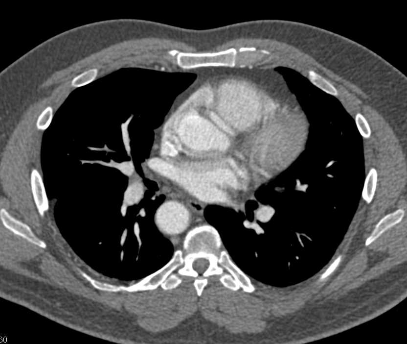 Incomplete Vascular Ring with Right Sided Arch - CTisus CT Scan