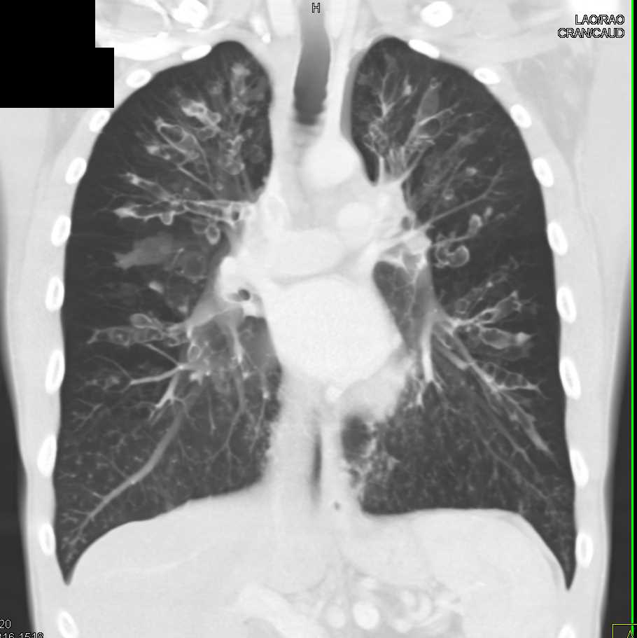 Cystic Bronchiectasis in Cystic Fibrosis - CTisus CT Scan