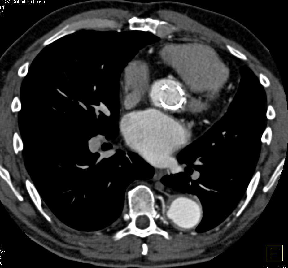 Thoracic Aorta Aneurysm Repair with Aortic Valve Replacement (AVR) - CTisus CT Scan