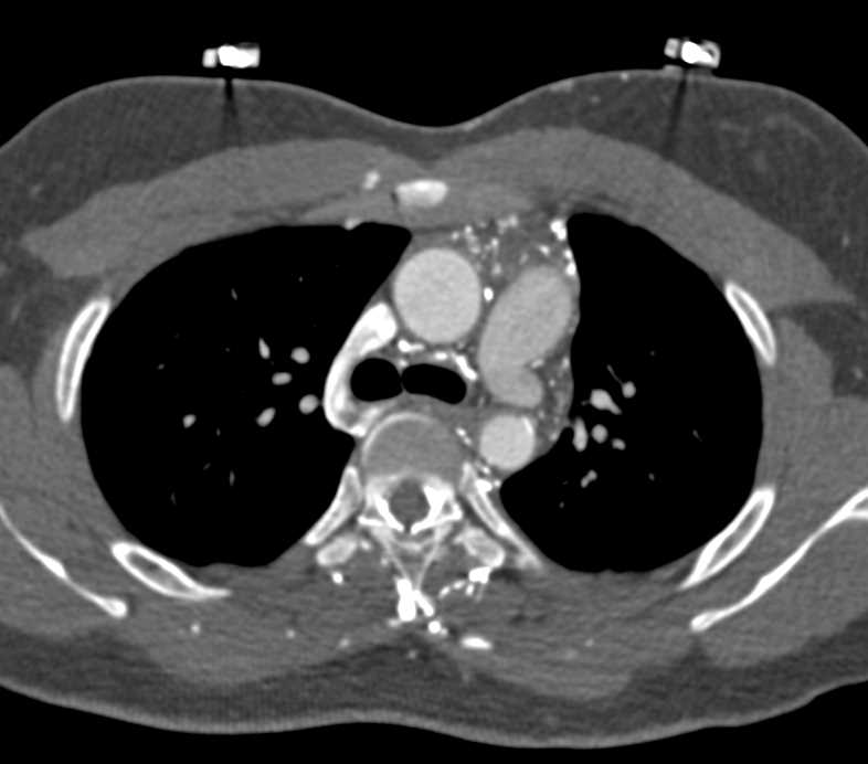 Vessel Stenosis with Colatterals - CTisus CT Scan