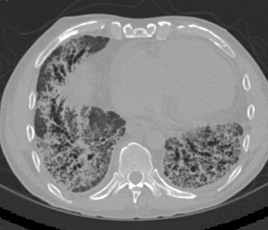 Interstitial Fibrosis Best Seen at the Bases - CTisus CT Scan