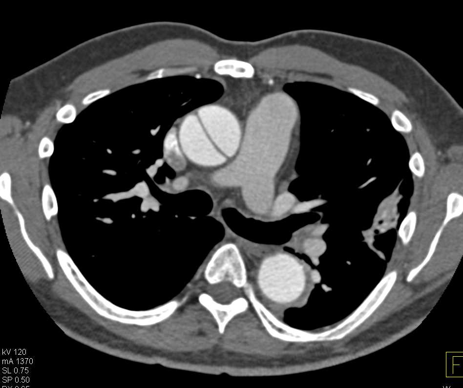 Type A Dissection - CTisus CT Scan