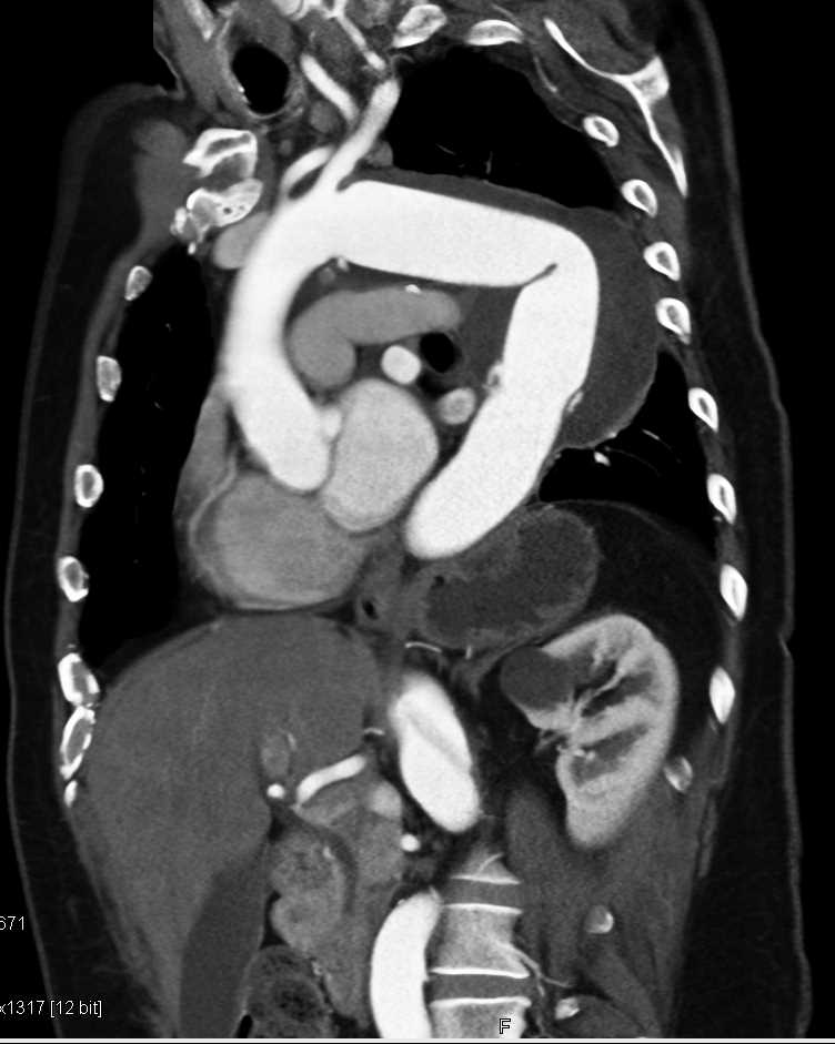 Elephant Trunk Repair Aortic Arch - CTisus CT Scan