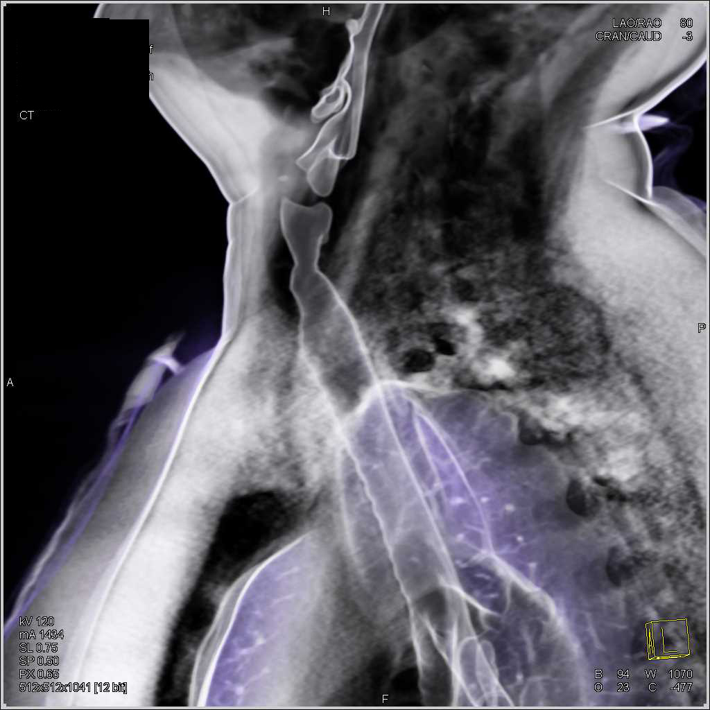 Tracheal Stenosis due to Inflammatory Stricture - CTisus CT Scan