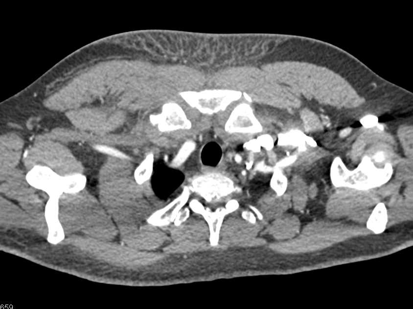 Cellulitis Chest Wall Following Clavicle Fracture - CTisus CT Scan