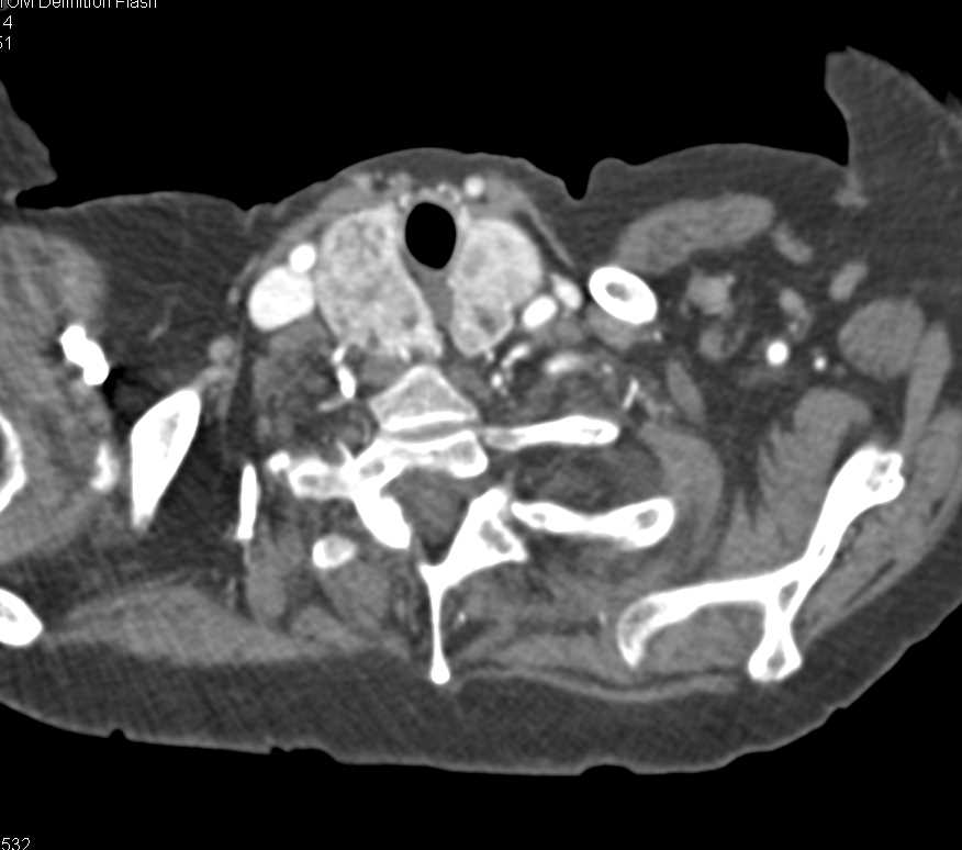 Substernal Extension of Thyroid Goiter - CTisus CT Scan