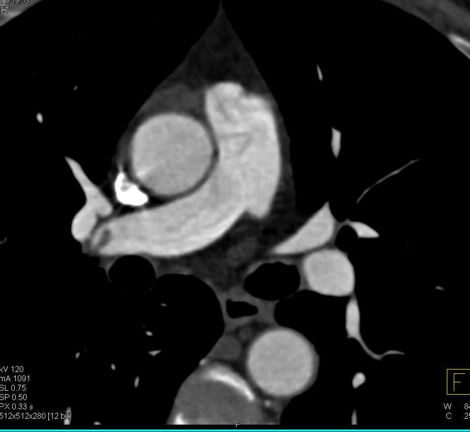 Chronic PE - CTisus CT Scan