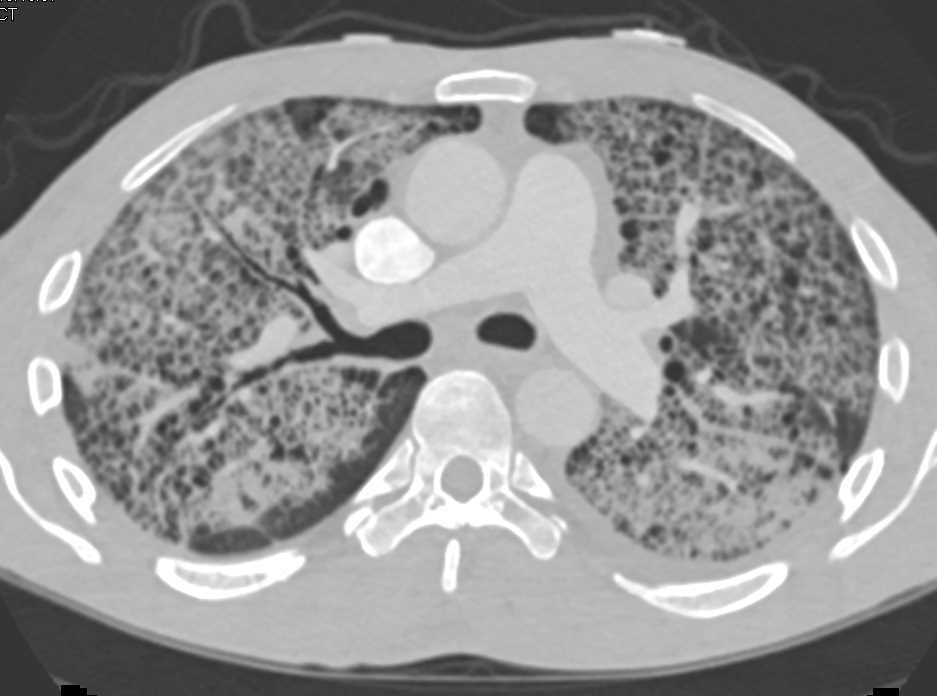Crazing Paving with Pulmonary Edema - CTisus CT Scan